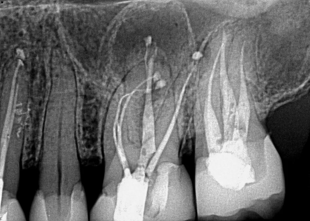 Case 1 x-ray after treatment, with the canals filled