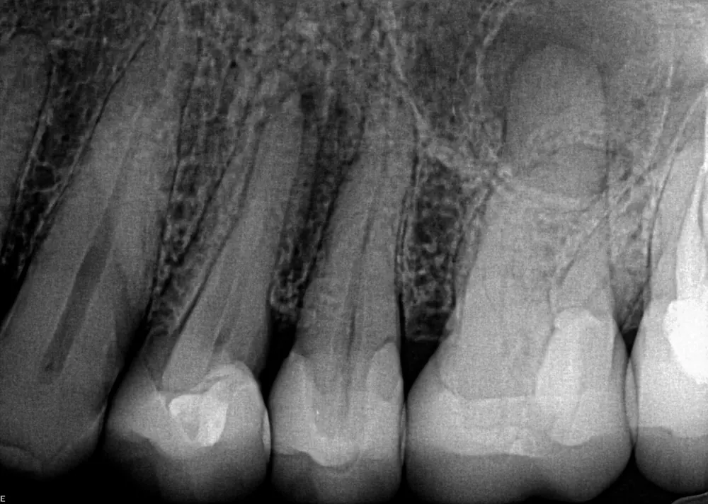 Case 1 x-ray before treatment