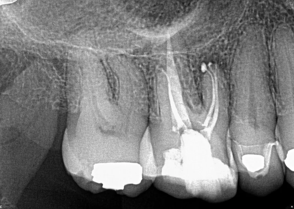 Case 2 x-ray after treatment, with the canals filled