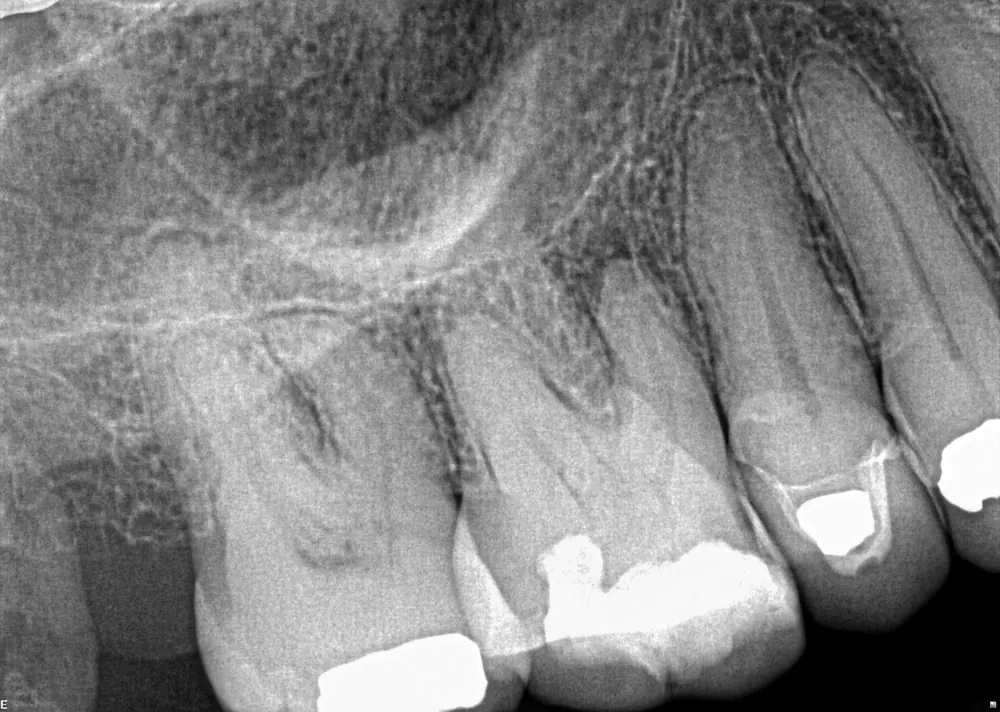 Case 2 x-ray before treatment