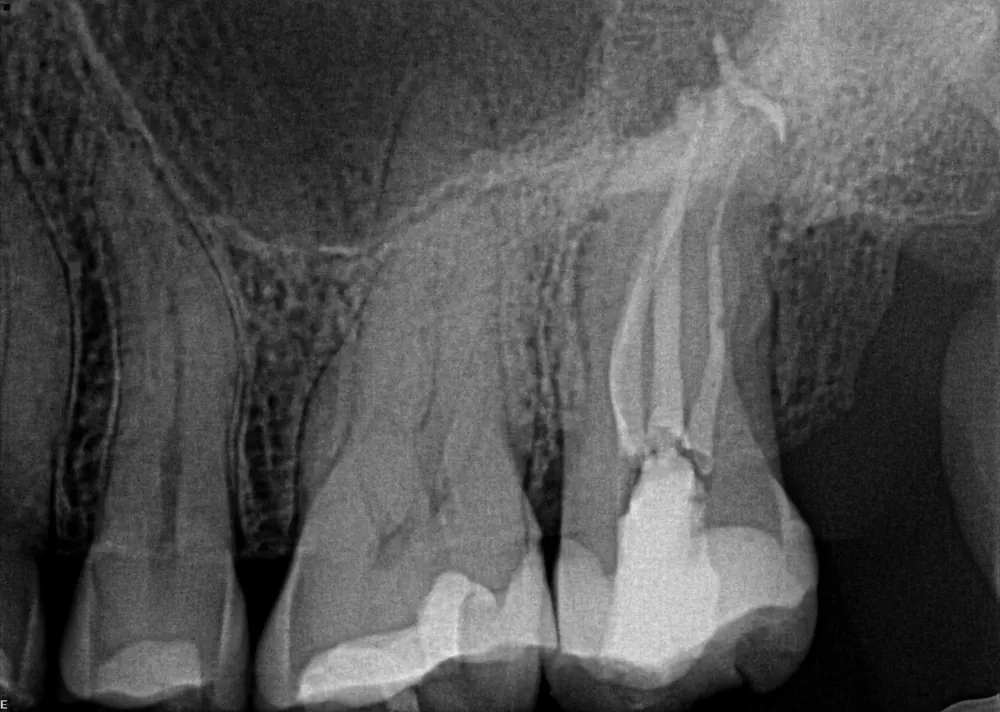Case 4 x-ray after treatment, with the canals filled
