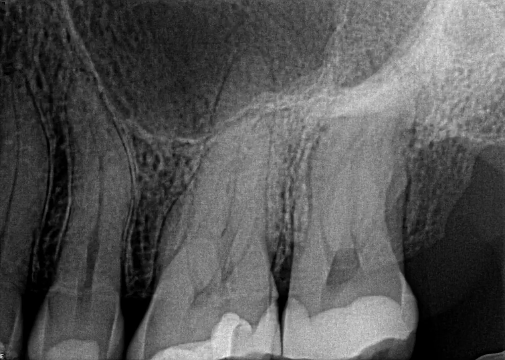 Case 4 x-ray before treatment
