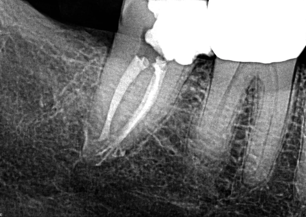 Case 5 x-ray after treatment, with the canals filled