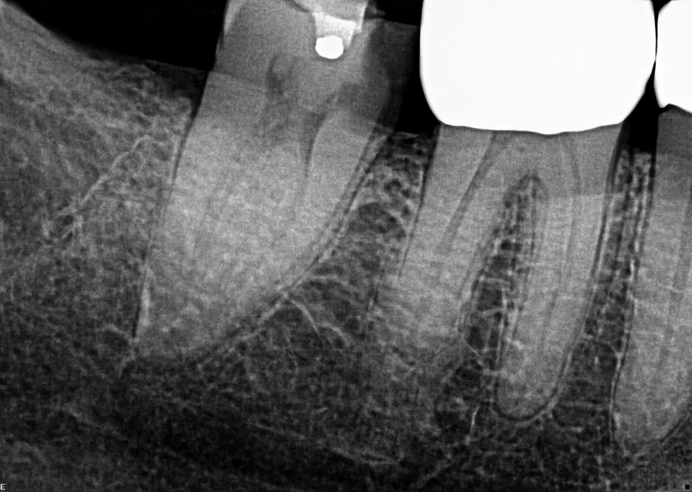 Case 5 x-ray before treatment