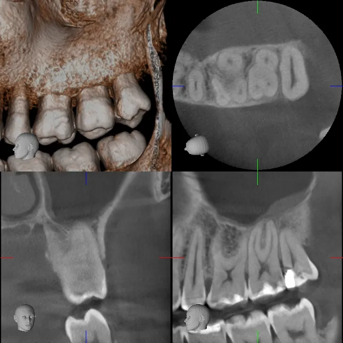 Cone beam CT views of upper teeth shown in 3D and in cross-section
